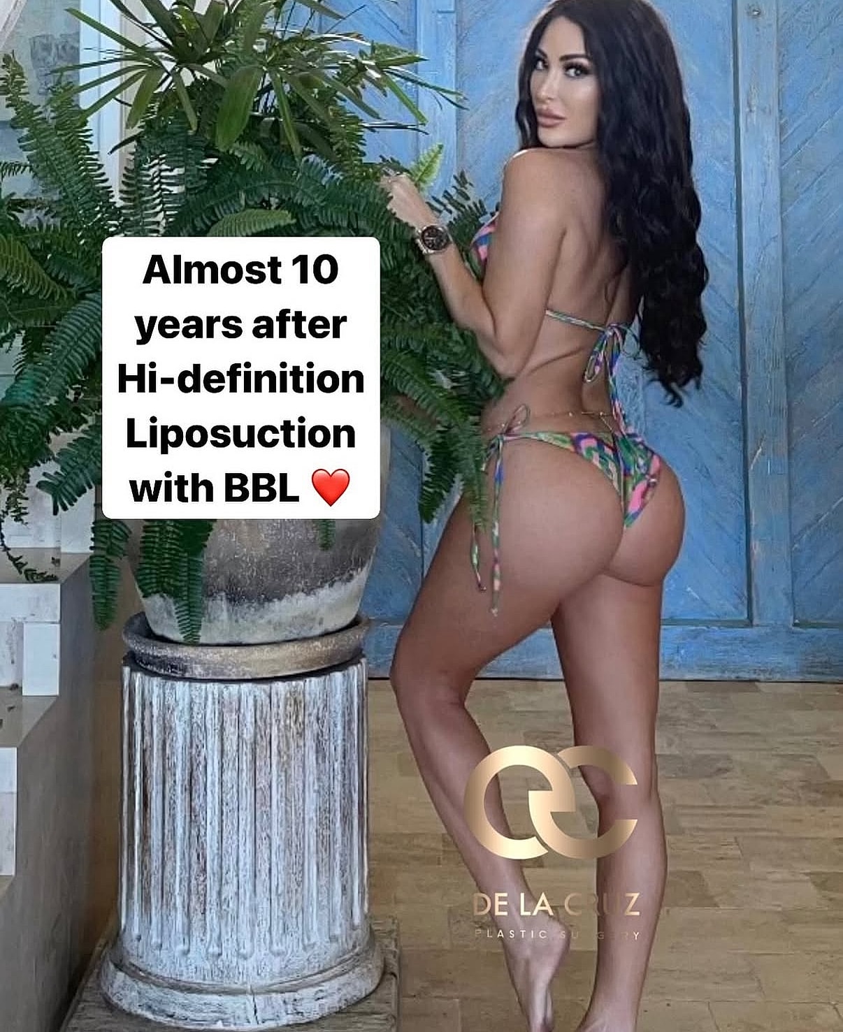 Figure showcasing results of BBL and liposuction.